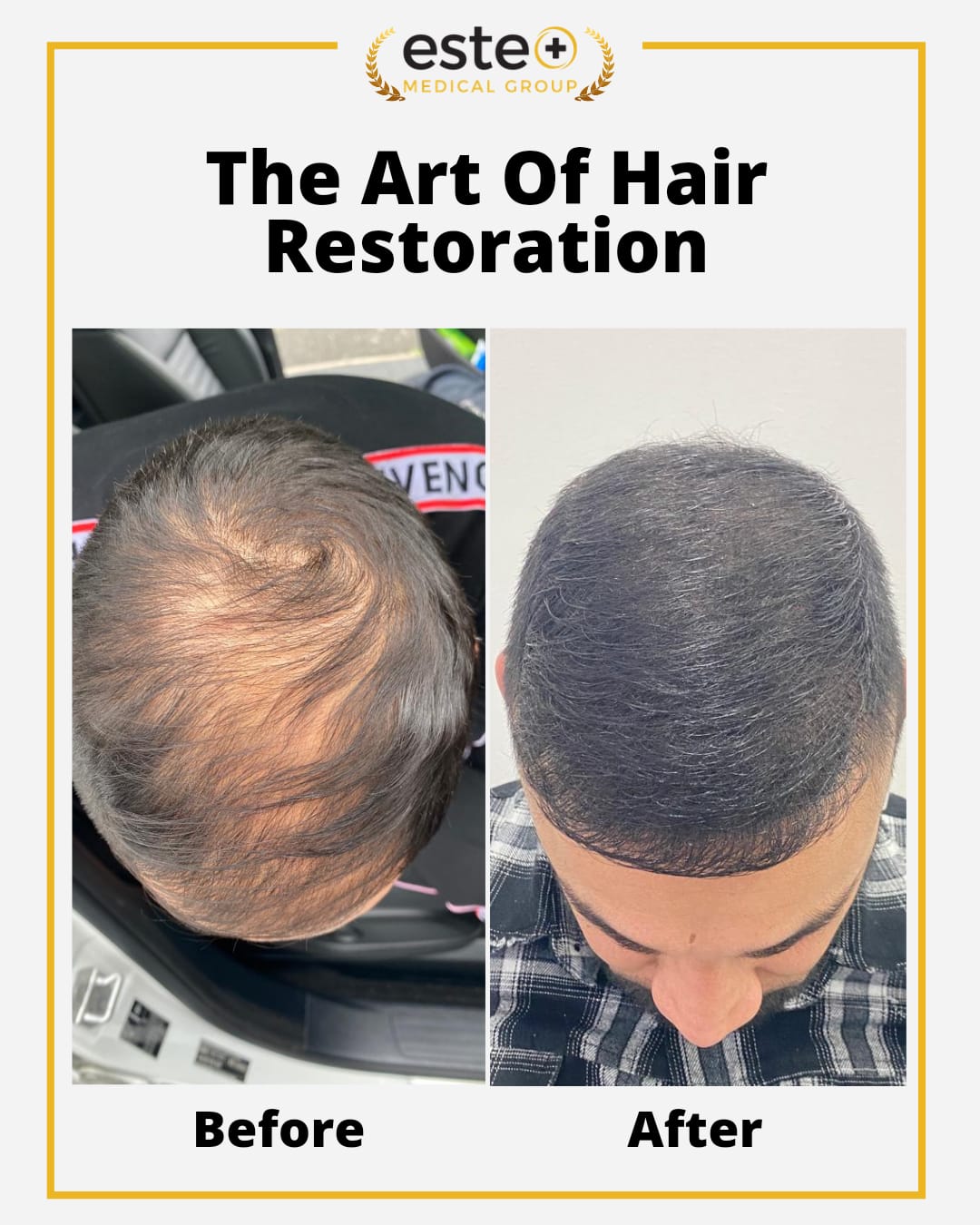 Guide to hair transplant Glasgow hair loss